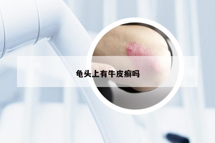龟头上有牛皮癣吗