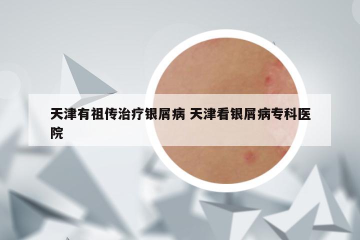 天津有祖传治疗银屑病 天津看银屑病专科医院