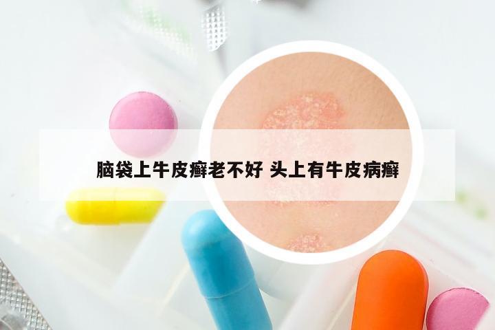 脑袋上牛皮癣老不好 头上有牛皮病癣