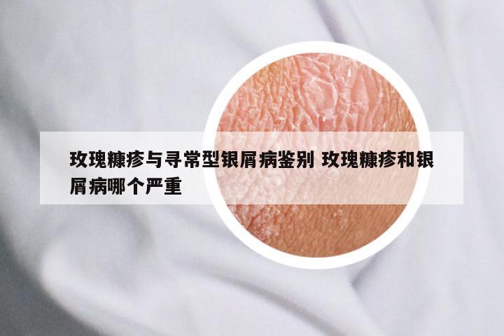 玫瑰糠疹与寻常型银屑病鉴别 玫瑰糠疹和银屑病哪个严重
