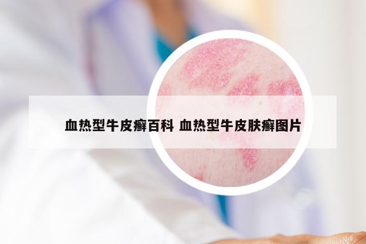 血热型牛皮癣百科 血热型牛皮肤癣图片