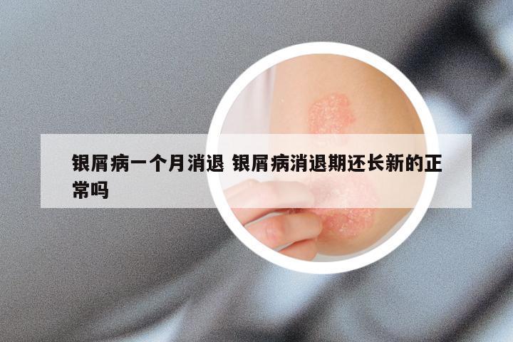 银屑病一个月消退 银屑病消退期还长新的正常吗