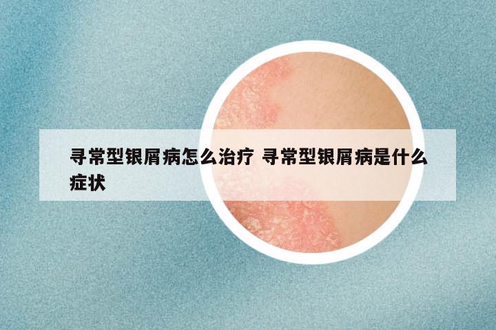 寻常型银屑病怎么治疗 寻常型银屑病是什么症状
