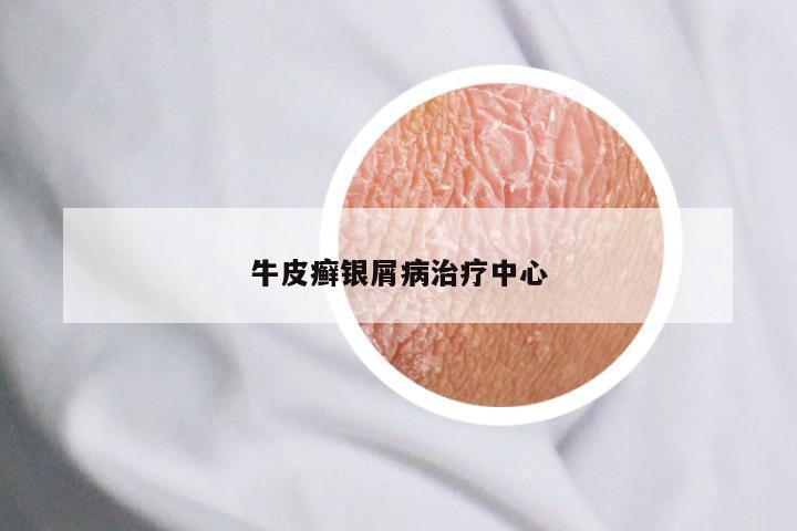 牛皮癣银屑病治疗中心