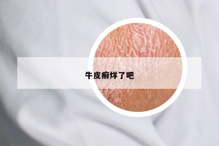 牛皮癣烊了吧