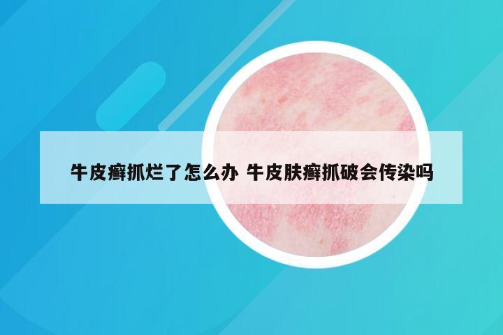 牛皮癣抓烂了怎么办 牛皮肤癣抓破会传染吗