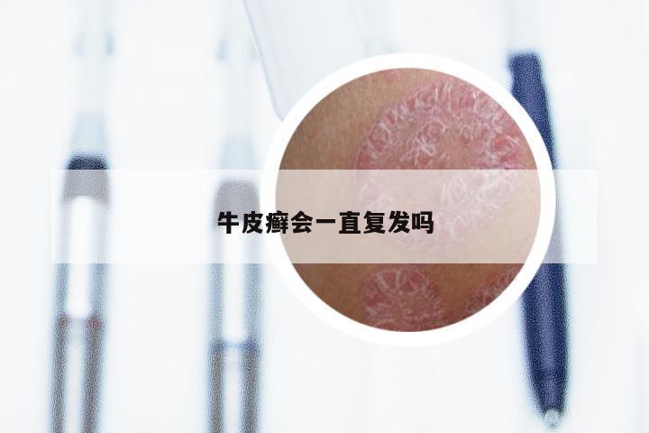 牛皮癣会一直复发吗