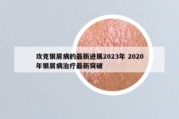 攻克银屑病的最新进展2023年 2020年银屑病治疗最新突破