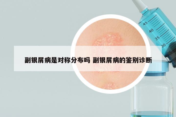 副银屑病是对称分布吗 副银屑病的鉴别诊断