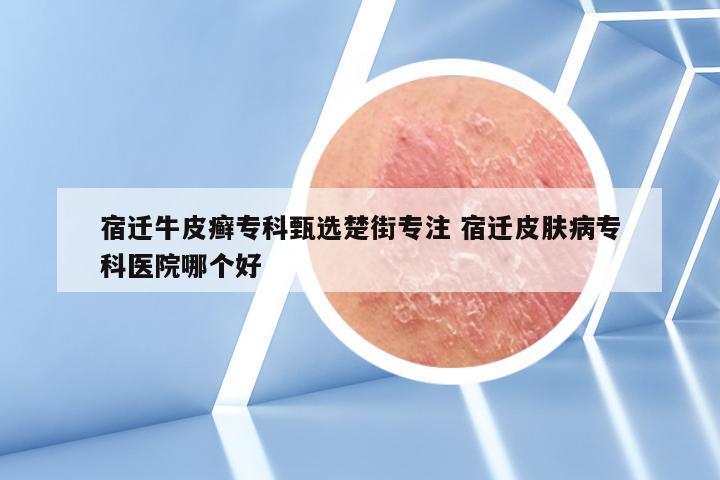 宿迁牛皮癣专科甄选楚街专注 宿迁皮肤病专科医院哪个好