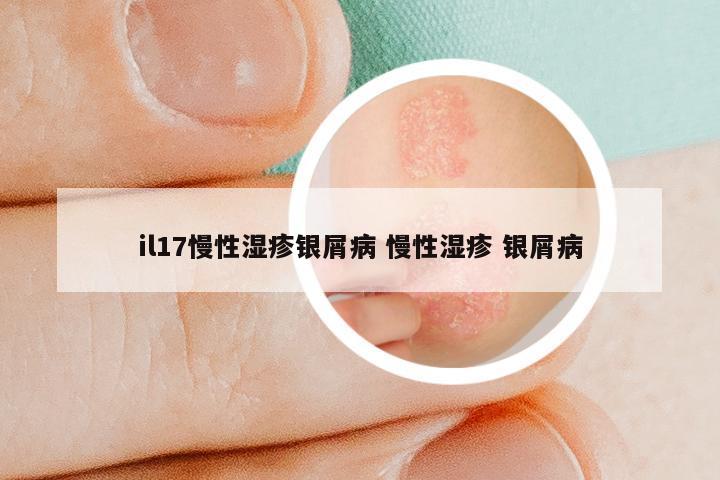 il17慢性湿疹银屑病 慢性湿疹 银屑病