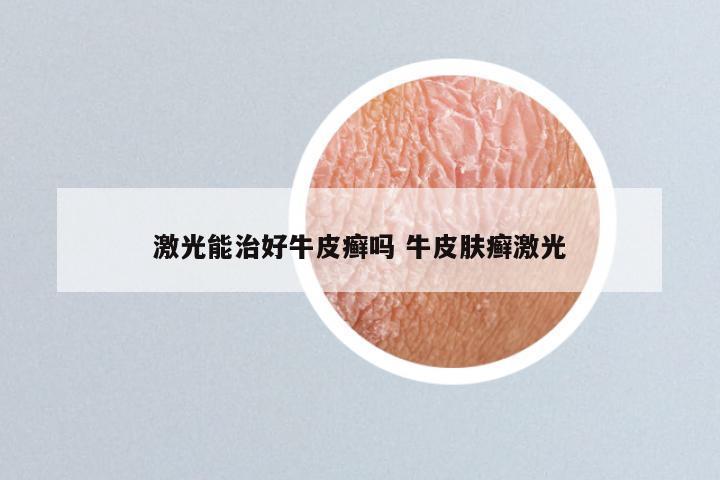 激光能治好牛皮癣吗 牛皮肤癣激光