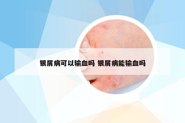 银屑病可以输血吗 银屑病能输血吗