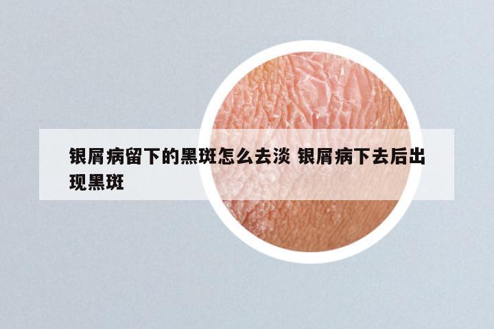 银屑病留下的黑斑怎么去淡 银屑病下去后出现黑斑