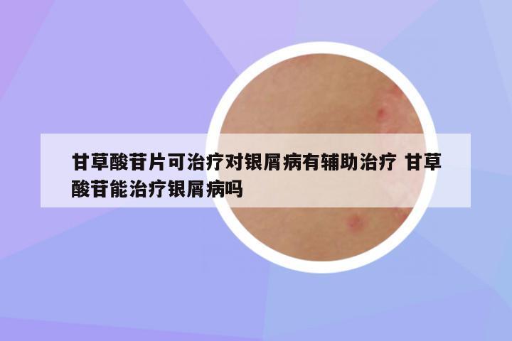甘草酸苷片可治疗对银屑病有辅助治疗 甘草酸苷能治疗银屑病吗
