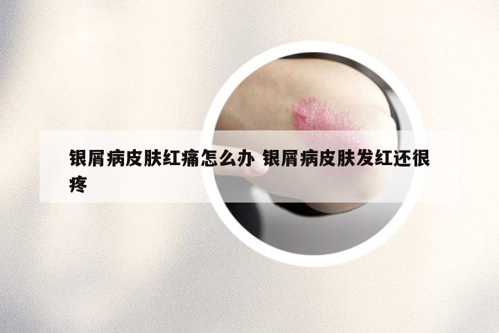 银屑病皮肤红痛怎么办 银屑病皮肤发红还很疼