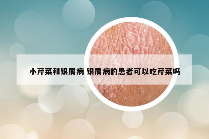 小芹菜和银屑病 银屑病的患者可以吃芹菜吗