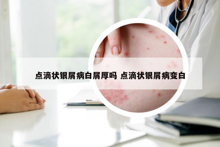 点滴状银屑病白屑厚吗 点滴状银屑病变白