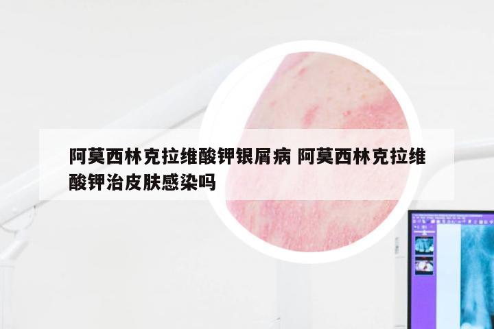 阿莫西林克拉维酸钾银屑病 阿莫西林克拉维酸钾治皮肤感染吗