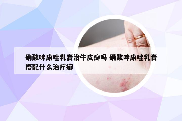 硝酸咪康唑乳膏治牛皮癣吗 硝酸咪康唑乳膏搭配什么治疗癣