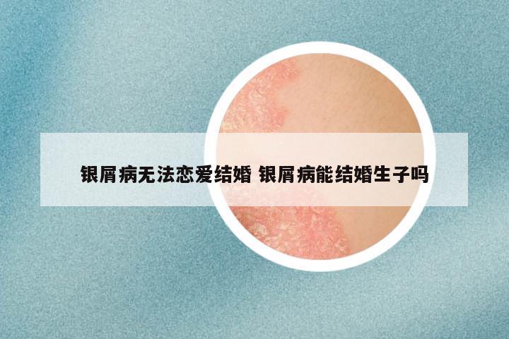 银屑病无法恋爱结婚 银屑病能结婚生子吗
