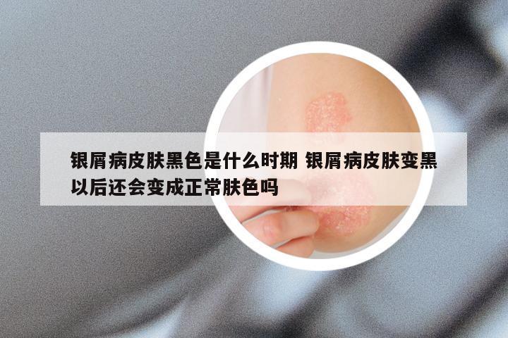 银屑病皮肤黑色是什么时期 银屑病皮肤变黑以后还会变成正常肤色吗
