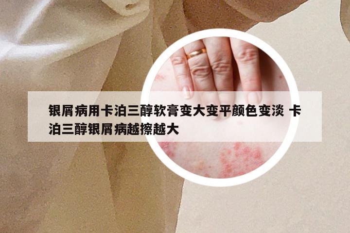 银屑病用卡泊三醇软膏变大变平颜色变淡 卡泊三醇银屑病越擦越大