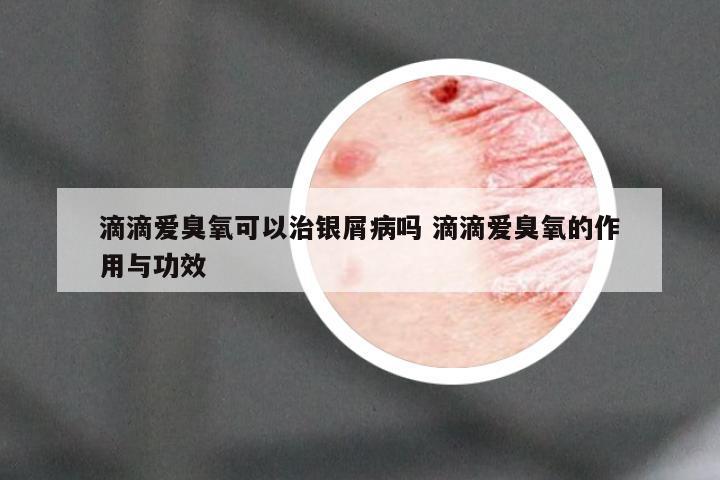 滴滴爱臭氧可以治银屑病吗 滴滴爱臭氧的作用与功效