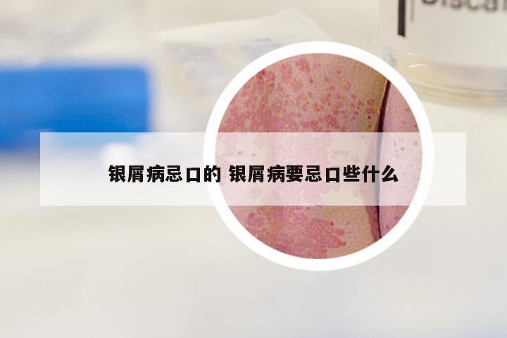 银屑病忌口的 银屑病要忌口些什么