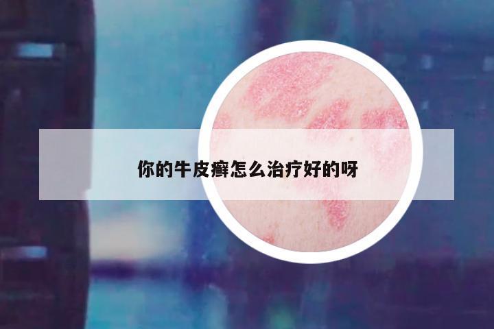 你的牛皮癣怎么治疗好的呀