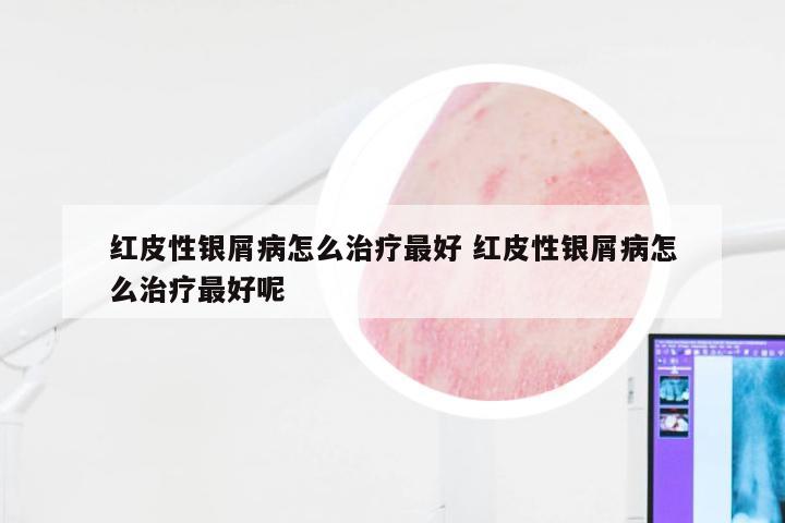 红皮性银屑病怎么治疗最好 红皮性银屑病怎么治疗最好呢