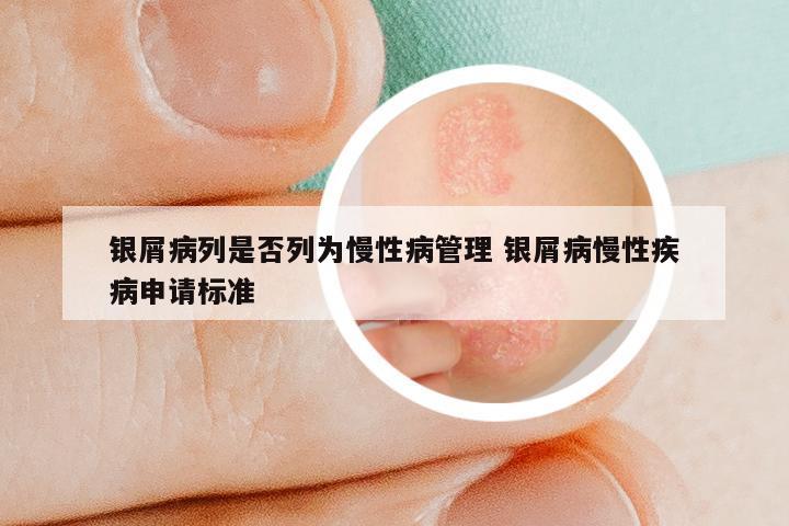 银屑病列是否列为慢性病管理 银屑病慢性疾病申请标准