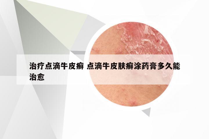 治疗点滴牛皮癣 点滴牛皮肤癣涂药膏多久能治愈