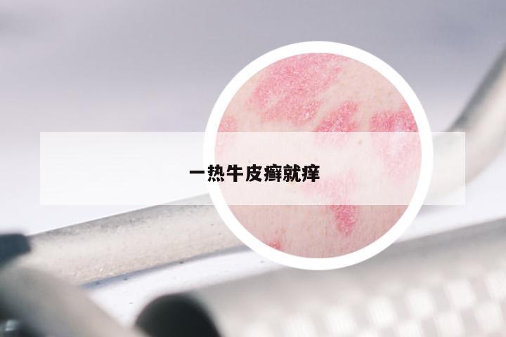 一热牛皮癣就痒