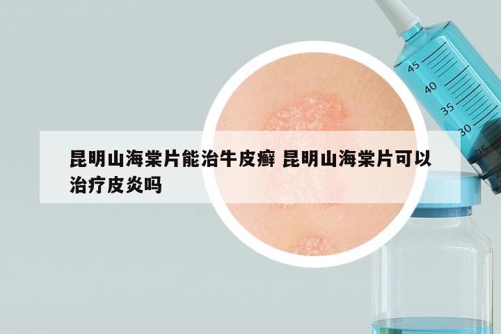昆明山海棠片能治牛皮癣 昆明山海棠片可以治疗皮炎吗