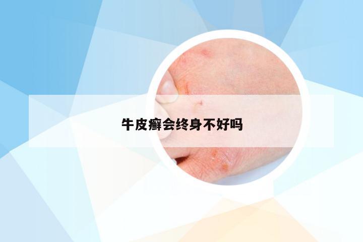 牛皮癣会终身不好吗