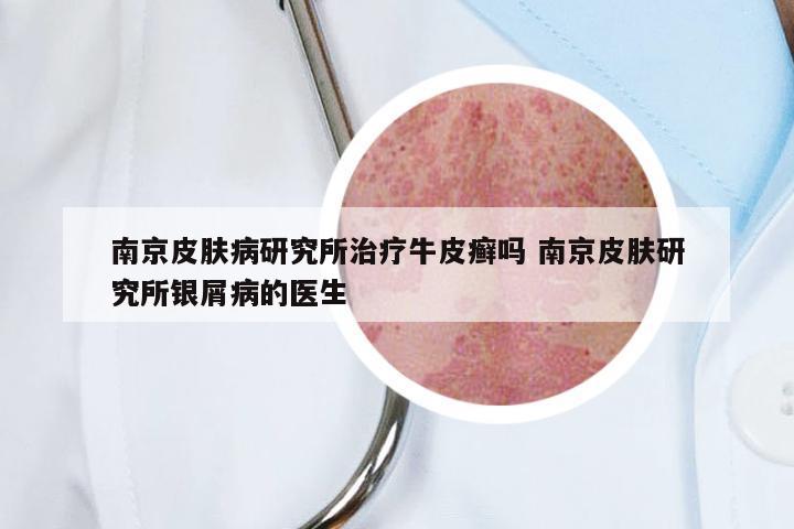 南京皮肤病研究所治疗牛皮癣吗 南京皮肤研究所银屑病的医生