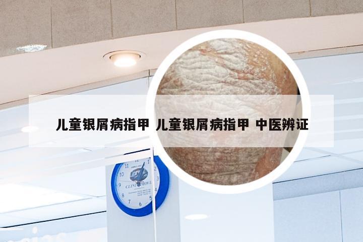儿童银屑病指甲 儿童银屑病指甲 中医辨证
