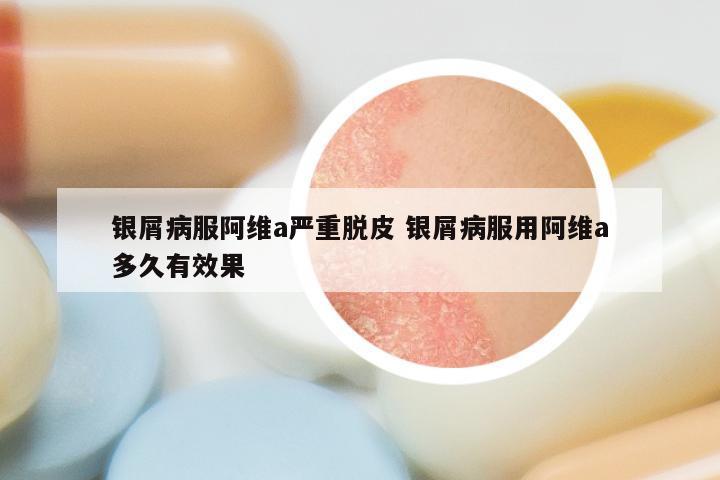 银屑病服阿维a严重脱皮 银屑病服用阿维a多久有效果