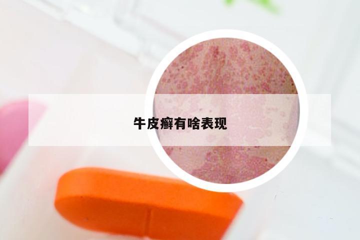 牛皮癣有啥表现