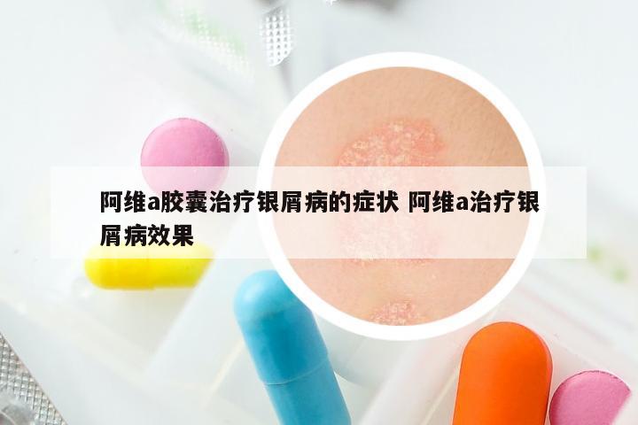 阿维a胶囊治疗银屑病的症状 阿维a治疗银屑病效果