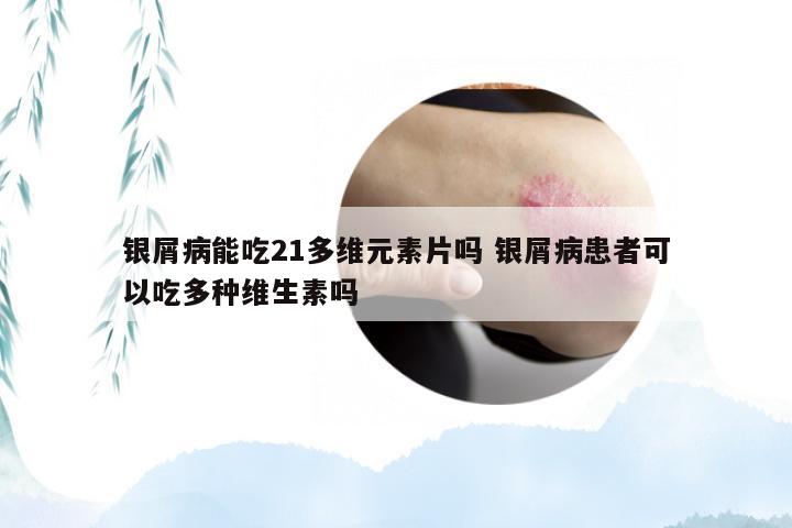 银屑病能吃21多维元素片吗 银屑病患者可以吃多种维生素吗