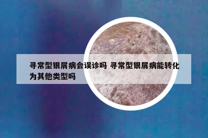 寻常型银屑病会误诊吗 寻常型银屑病能转化为其他类型吗
