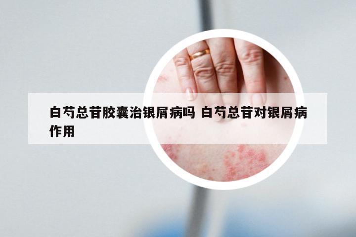 白芍总苷胶囊治银屑病吗 白芍总苷对银屑病作用