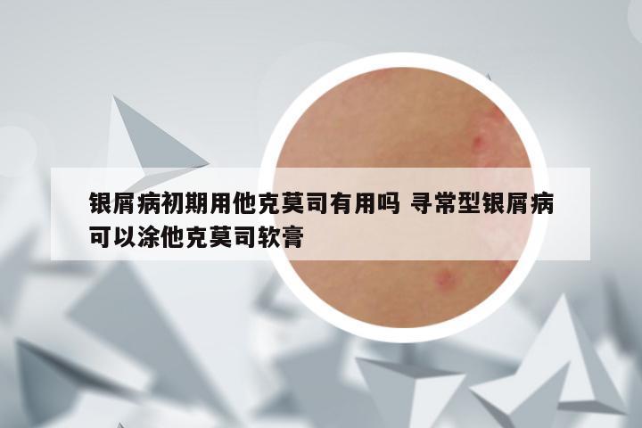 银屑病初期用他克莫司有用吗 寻常型银屑病可以涂他克莫司软膏