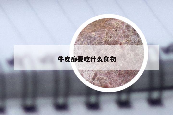 牛皮癣要吃什么食物