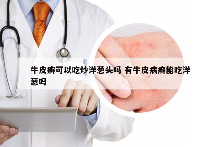 牛皮癣可以吃炒洋葱头吗 有牛皮病癣能吃洋葱吗