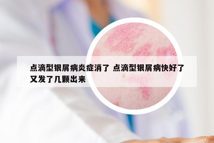 点滴型银屑病炎症消了 点滴型银屑病快好了又发了几颗出来