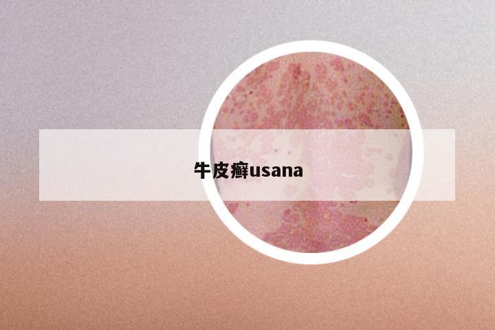 牛皮癣usana