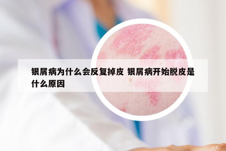 银屑病为什么会反复掉皮 银屑病开始脱皮是什么原因
